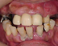 歯肉炎の写真