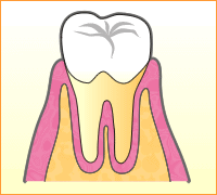 歯周病の進行イラスト1