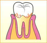 歯周病の進行イラスト2