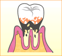 歯周病の進行イラスト4
