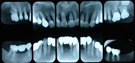 歯周病の方のレントゲン